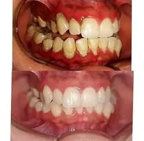 Blanchiment dentaire - Cas 5